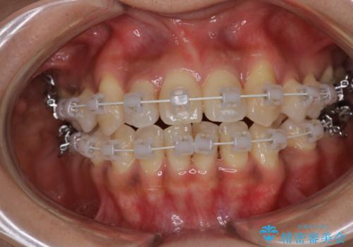 【審美装置】抜歯の本数最小限で行った矯正治療の治療中