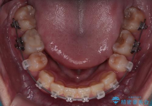 転勤でも安心して治療継続 抜歯スペース閉鎖と深い噛み合わせ改善のワイヤー矯正の治療中