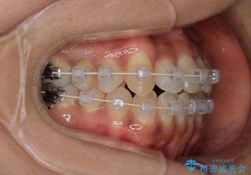 【審美装置】抜歯の本数最小限で行った矯正治療の治療中