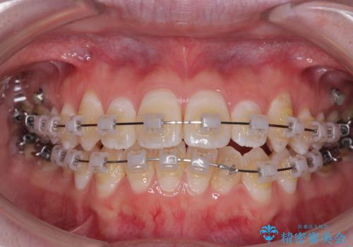 【モニター】前歯のデコボコをスッキリ解消!目立ちにくいワイヤー矯正でスピーディに治療完了の治療中