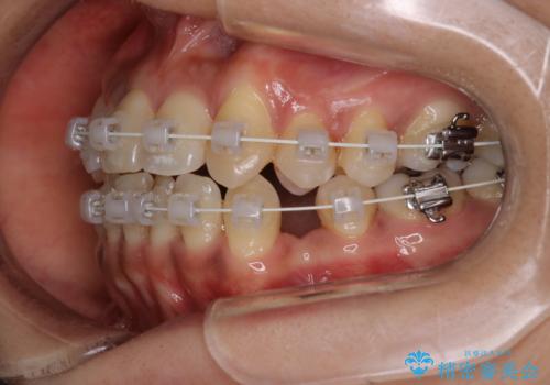 【審美装置】抜歯の本数最小限で行った矯正治療の治療中