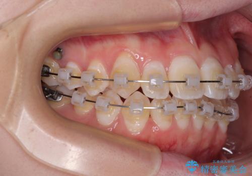 【モニター】前歯のデコボコをスッキリ解消!目立ちにくいワイヤー矯正でスピーディに治療完了の治療中