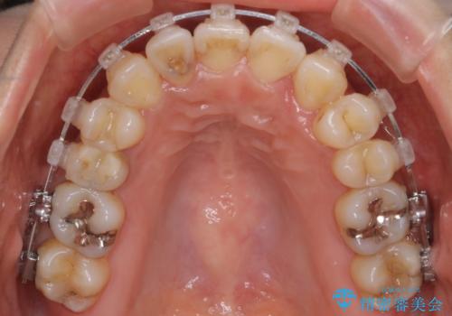 【審美装置】抜歯の本数最小限で行った矯正治療の治療中