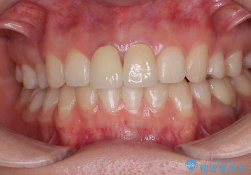 神経を取って変色した歯 オールセラミッククラウンで綺麗に仕上げるの治療後