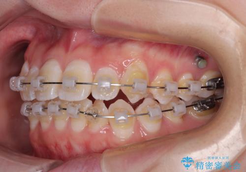 【モニター】前歯のデコボコをスッキリ解消!目立ちにくいワイヤー矯正でスピーディに治療完了の治療中