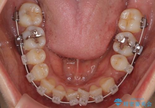 【審美装置】抜歯の本数最小限で行った矯正治療の治療中