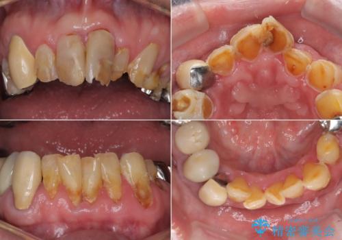 歯がボロボロで咬合崩壊 矯正・インプラント・セラミックで実現する、酸蝕症の総合治療の治療前