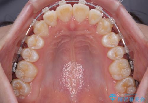 【モニター】前歯のデコボコをスッキリ解消!目立ちにくいワイヤー矯正でスピーディに治療完了の治療中