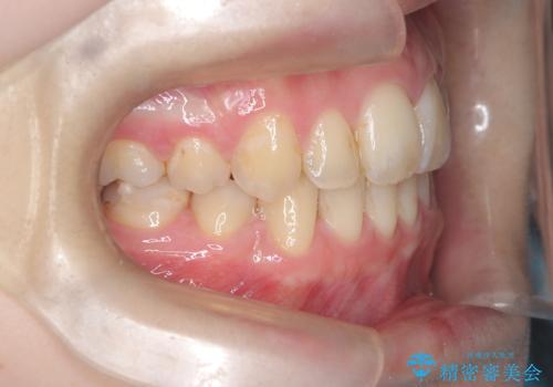 歯のデコボコ|口ボコ|八重歯が気になる!|ワイヤー矯正の治療後