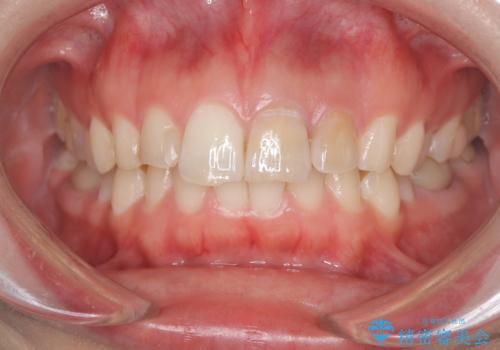 前歯が痛い!|歯の色が気になる!|精密根管治療後、オールセラミッククラウンで審美修復の治療前