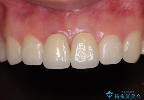 神経を取って変色した歯 オールセラミッククラウンで綺麗に仕上げるの症例 治療後