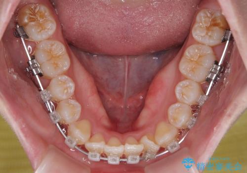 【モニター】前歯のデコボコをスッキリ解消!目立ちにくいワイヤー矯正でスピーディに治療完了の治療中