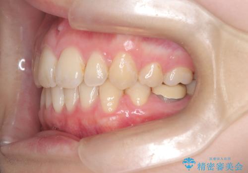 歯のデコボコ|口ボコ|八重歯が気になる!|ワイヤー矯正の治療後