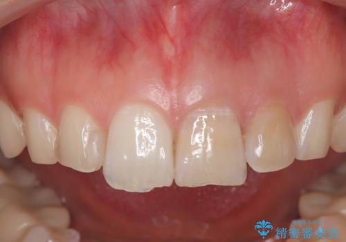 前歯が痛い!|歯の色が気になる!|精密根管治療後、オールセラミッククラウンで審美修復の治療前