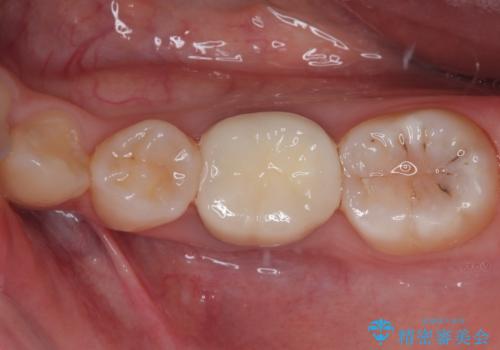 神経を取って変色した歯 オールセラミッククラウンで綺麗に仕上げるの治療後