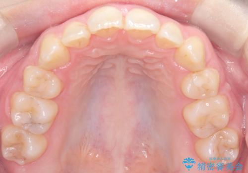 歯のデコボコ|口ボコ|八重歯が気になる!|ワイヤー矯正の治療後