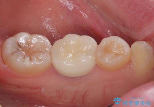 神経を取って変色した歯 オールセラミッククラウンで綺麗に仕上げるの治療後