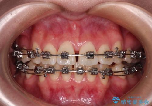 【モニター】とがった口元を抜歯して改善 ワイヤー装置の矯正治療の治療中