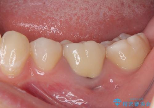神経を取って変色した歯 オールセラミッククラウンで綺麗に仕上げるの治療後