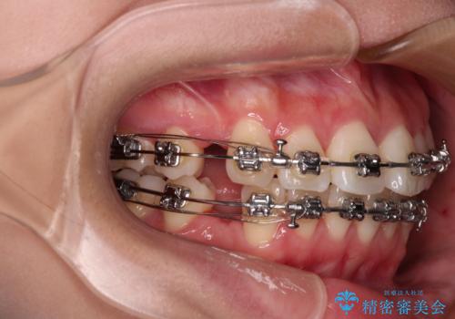 【モニター】とがった口元を抜歯して改善 ワイヤー装置の矯正治療の治療中