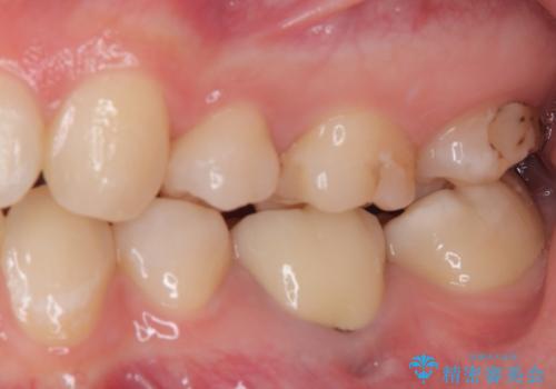 神経を取って変色した歯 オールセラミッククラウンで綺麗に仕上げるの治療後