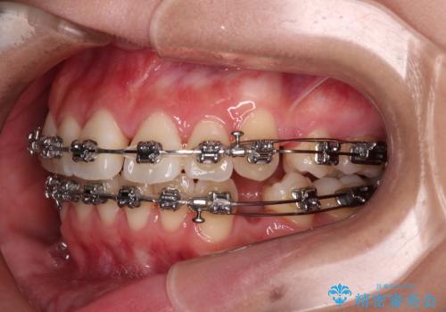 【モニター】とがった口元を抜歯して改善 ワイヤー装置の矯正治療の治療中