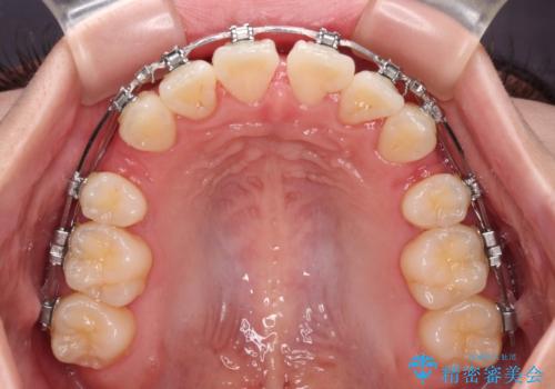 【モニター】とがった口元を抜歯して改善 ワイヤー装置の矯正治療の治療中