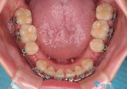 【モニター】とがった口元を抜歯して改善 ワイヤー装置の矯正治療の治療中