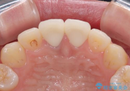 神経を取って変色した歯 オールセラミッククラウンで綺麗に仕上げるの治療後
