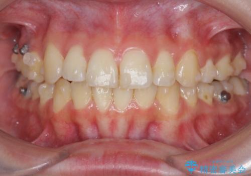 マウスピースで行う出っ歯の改善 後方移動の治療前