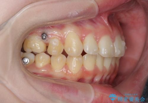 マウスピースで行う出っ歯の改善 後方移動の治療前