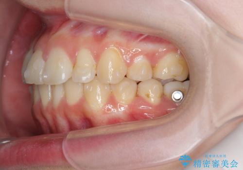 マウスピースで行う出っ歯の改善 後方移動の治療前
