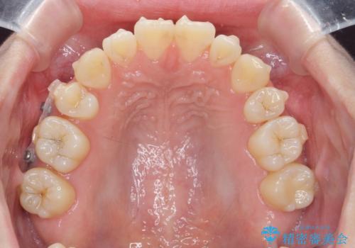 マウスピースで行う出っ歯の改善 後方移動の治療前