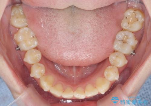 マウスピースで行う出っ歯の改善 後方移動の治療前