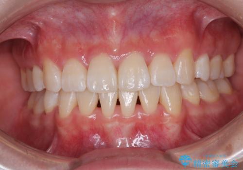 【モニター】とがった口元を抜歯して改善 ワイヤー装置の矯正治療の症例 治療後