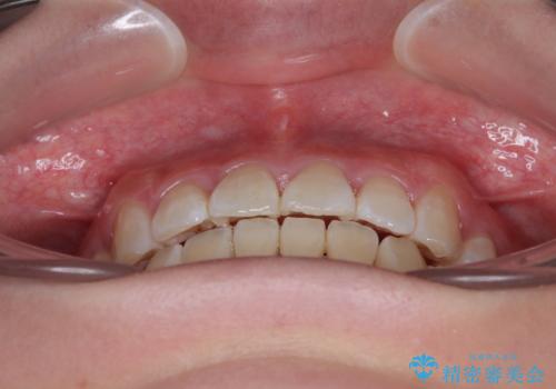 【モニター】とがった口元を抜歯して改善 ワイヤー装置の矯正治療の治療後