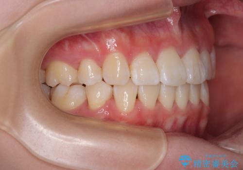 【モニター】とがった口元を抜歯して改善 ワイヤー装置の矯正治療の治療後