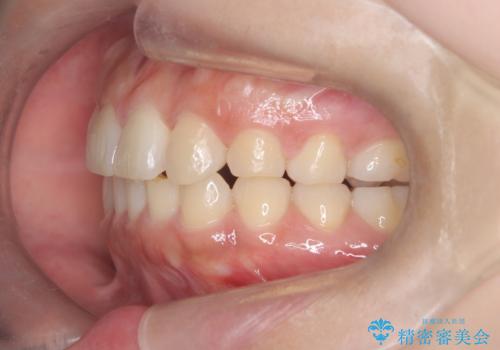 歯のデコボコを治したい! |インビザラインでわずか6ヵ月で矯正完了!の治療後