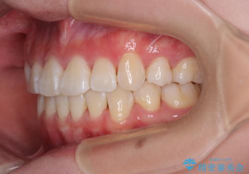【モニター】とがった口元を抜歯して改善 ワイヤー装置の矯正治療の治療後