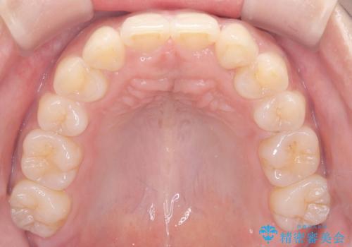 歯のデコボコを治したい! |インビザラインでわずか6ヵ月で矯正完了!の治療後
