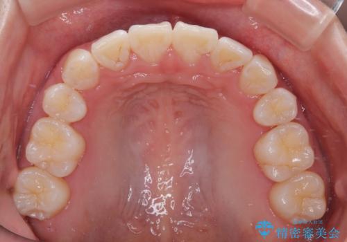 【モニター】とがった口元を抜歯して改善 ワイヤー装置の矯正治療の治療後