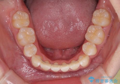 【モニター】とがった口元を抜歯して改善 ワイヤー装置の矯正治療の治療後