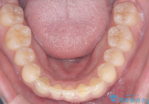 歯のデコボコを治したい! |インビザラインでわずか6ヵ月で矯正完了!の治療後