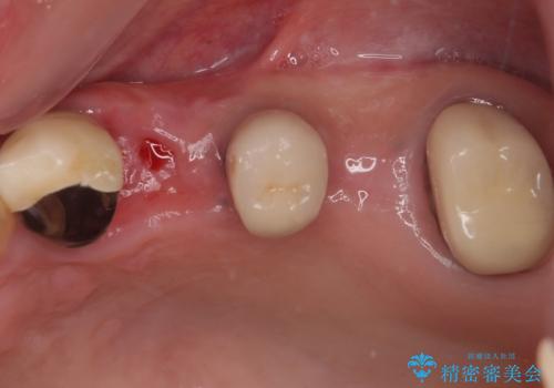 抜歯が必要な歯をインプラントに 短期間インプラント治療の治療前