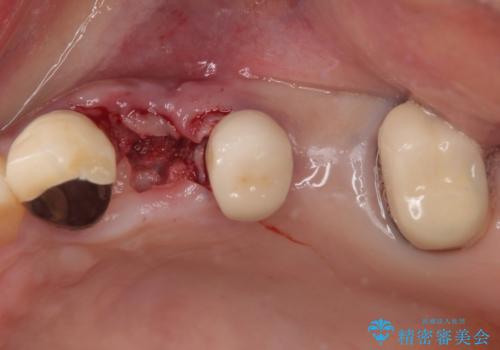 抜歯が必要な歯をインプラントに 短期間インプラント治療の治療中