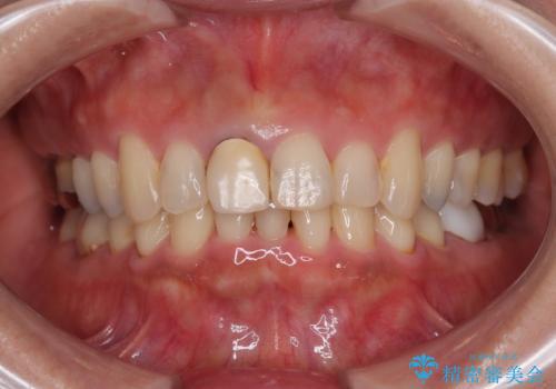 不自然な色彩の前歯 オールセラミッククラウンで自然な口元にの治療前