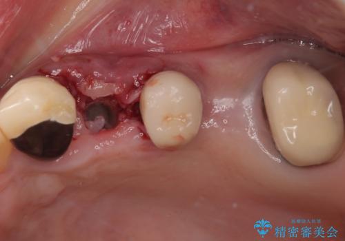 抜歯が必要な歯をインプラントに 短期間インプラント治療の治療後