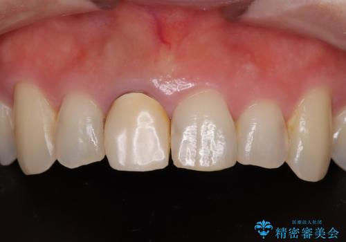 不自然な色彩の前歯 オールセラミッククラウンで自然な口元にの症例 治療前