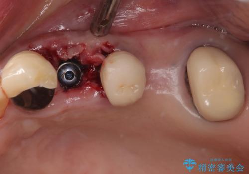 抜歯が必要な歯をインプラントに 短期間インプラント治療の治療前