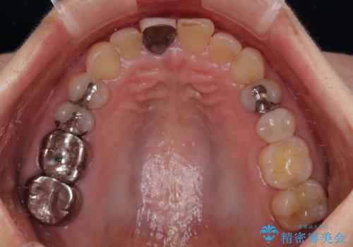 不自然な色彩の前歯 オールセラミッククラウンで自然な口元にの治療前